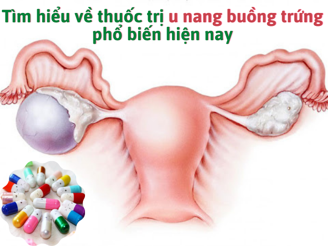 Tìm hiểu về thuốc trị u nang buồng trứng phổ biến hiện nay